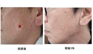 頬部の粉瘤をくりぬき法で手術した術直後と術後7年の比較写真。術後7年では傷跡がほぼ消失。大阪・新大阪のクリニックでの日帰り手術。