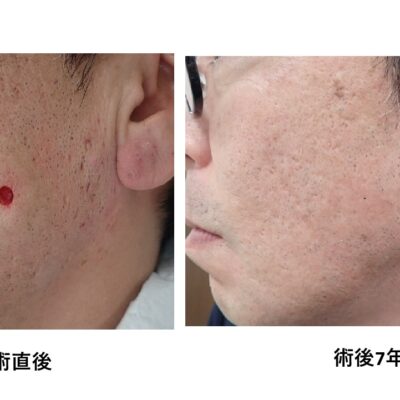 頬部の粉瘤をくりぬき法で手術した術直後と術後7年の比較写真。術後7年では傷跡がほぼ消失。大阪・新大阪のクリニックでの日帰り手術。