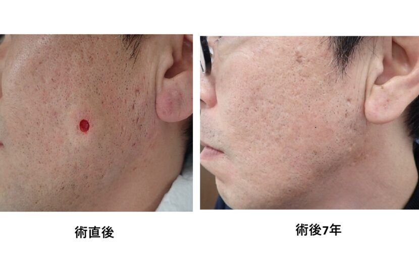 頬部の粉瘤をくりぬき法で手術した術直後と術後7年の比較写真。術後7年では傷跡がほぼ消失。大阪・新大阪のクリニックでの日帰り手術。