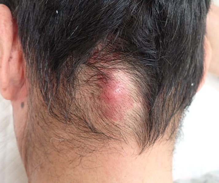 首の後ろ、襟足の生え際にできた赤く腫れた粉瘤(術前)