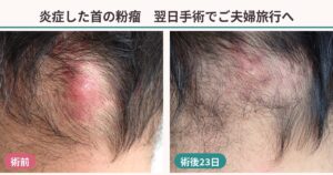 炎症した後頚部の粉瘤の術前と、くりぬき法で摘出して23日後の比較