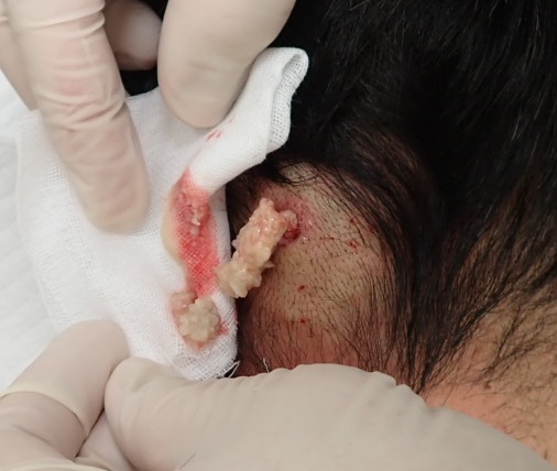 後頚部の粉瘤をくりぬき法で手術中、小さな穴から白い内容物を排出している様子