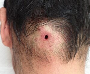 後頚部の粉瘤をくりぬき法で摘出した直後の、小さな丸い傷