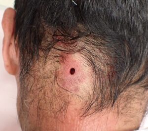 後頚部の粉瘤をくりぬき法で摘出した翌日の傷。術前より赤みと腫れが引いている