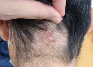 後頚部の粉瘤をくりぬき法で摘出して15日目の傷。穴はふさがり、薄いピンク色の跡が残っている