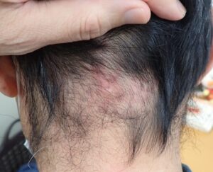 後頚部の粉瘤をくりぬき法で摘出して23日目。赤みが薄くなり、傷あとが目立たなくなっている