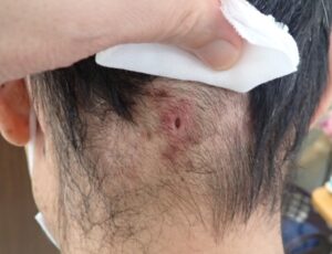 後頚部の粉瘤をくりぬき法で摘出して8日目の傷。穴が小さくなり、周りの赤みも引いてきている